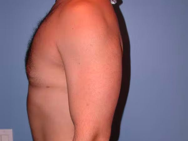 Male Liposuction Gallery - Patient 6097150 - Image 4
