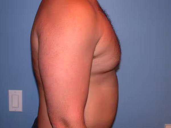 Male Liposuction Before & After Gallery - Patient 6097150 - Image 5