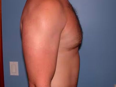 Male Liposuction Gallery Before & After Gallery - Patient 6097150 - Image 6