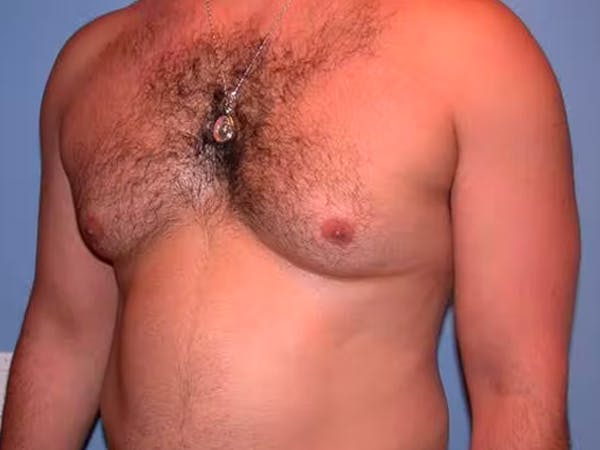 Male Liposuction Before & After Gallery - Patient 6097150 - Image 7