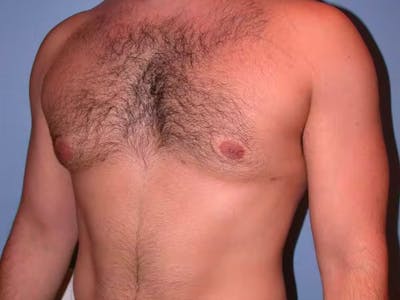 Male Liposuction Gallery Before & After Gallery - Patient 6097150 - Image 8