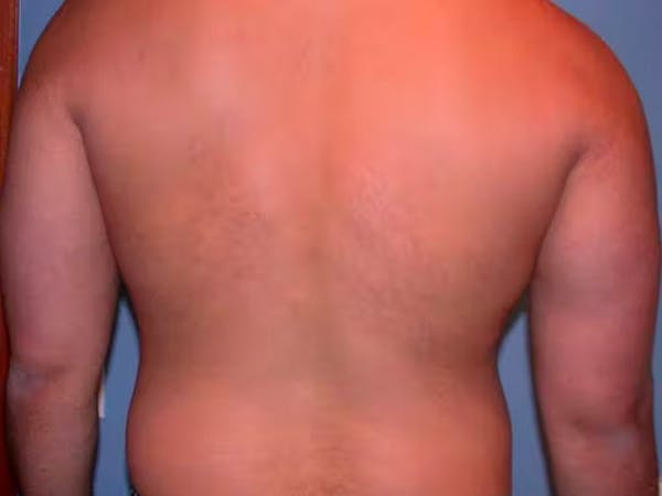 Male Liposuction Gallery Before & After Gallery - Patient 6097150 - Image 9