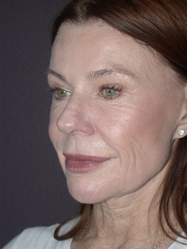 Facelift Gallery Before & After Gallery - Patient 120815768 - Image 1