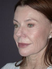 Facelift Before & After Gallery - Patient 120815768 - Image 1
