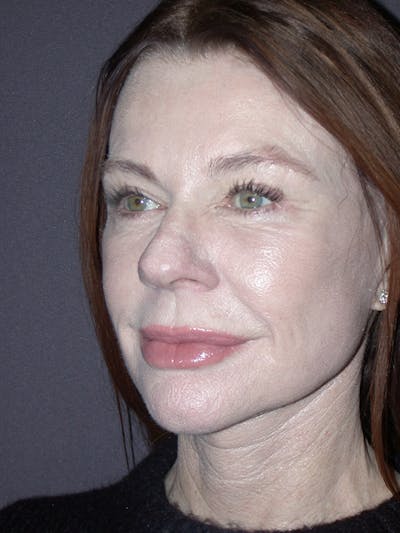 Facelift Gallery Before & After Gallery - Patient 120815768 - Image 2