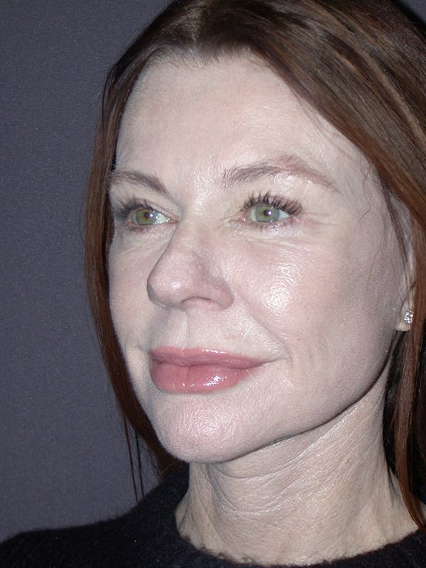 Eyelid Lift Gallery Before & After Gallery - Patient 120815773 - Image 2