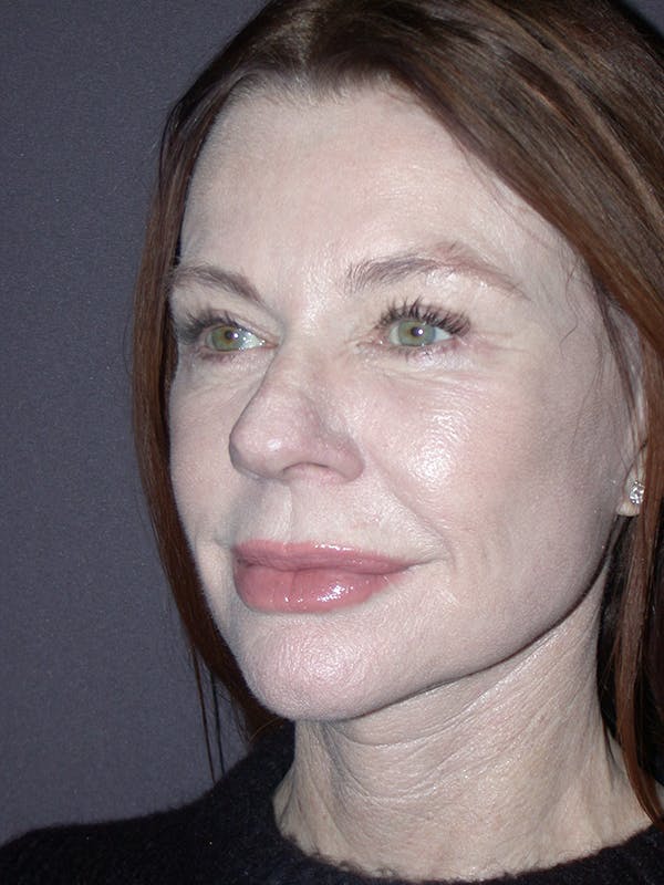Facelift Before & After Gallery - Patient 120815768 - Image 2