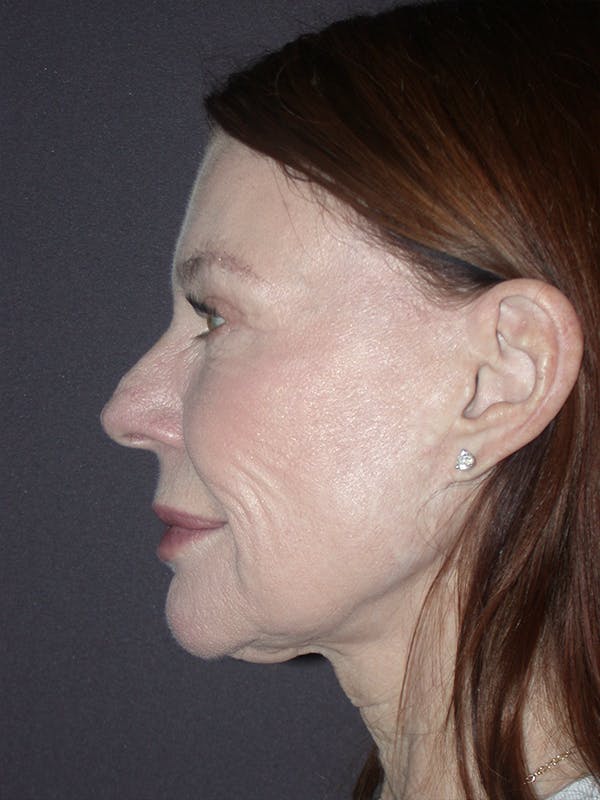 Facelift Gallery Before & After Gallery - Patient 120815768 - Image 3