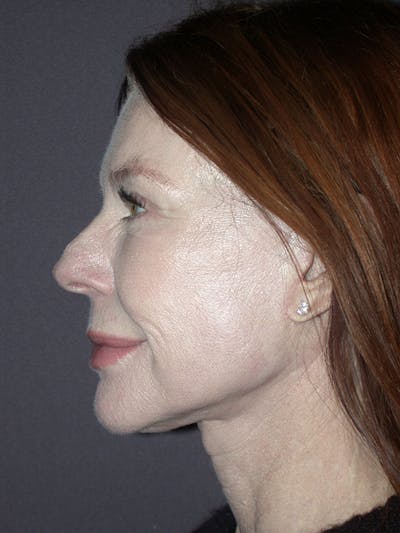 Facelift Gallery Before & After Gallery - Patient 120815768 - Image 4