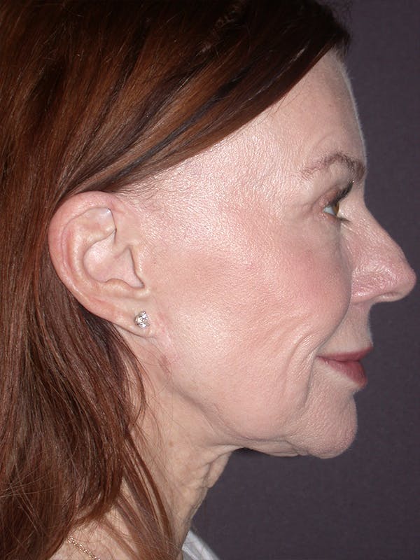 Facelift Gallery Before & After Gallery - Patient 120815768 - Image 5