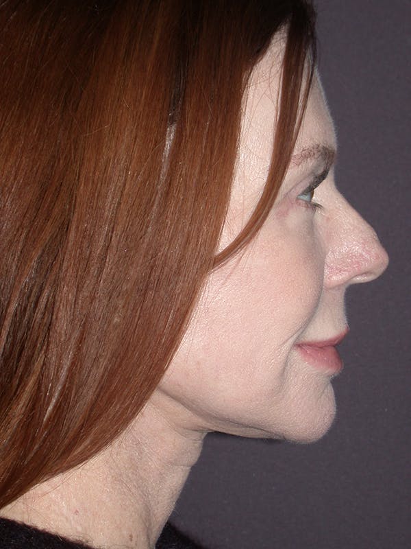 Facelift Gallery Before & After Gallery - Patient 120815768 - Image 6