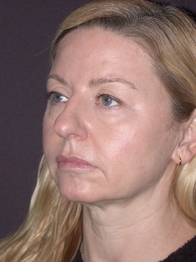 Eyelid Lift Gallery Before & After Gallery - Patient 120815837 - Image 1