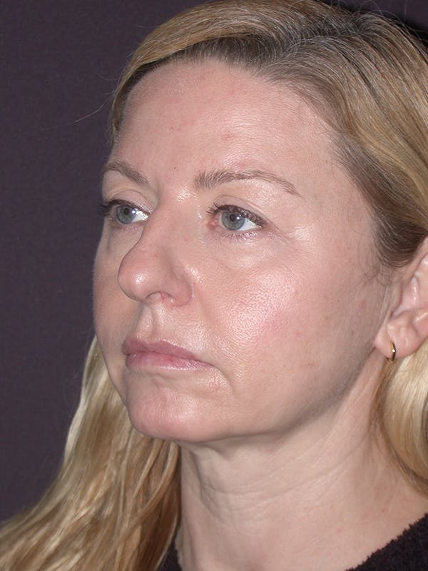 Facelift Gallery Before & After Gallery - Patient 120815835 - Image 1