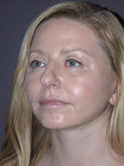 Facelift Gallery Before & After Gallery - Patient 120815835 - Image 2