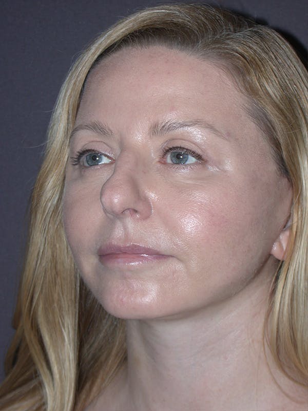 Facelift Before & After Gallery - Patient 120815835 - Image 2