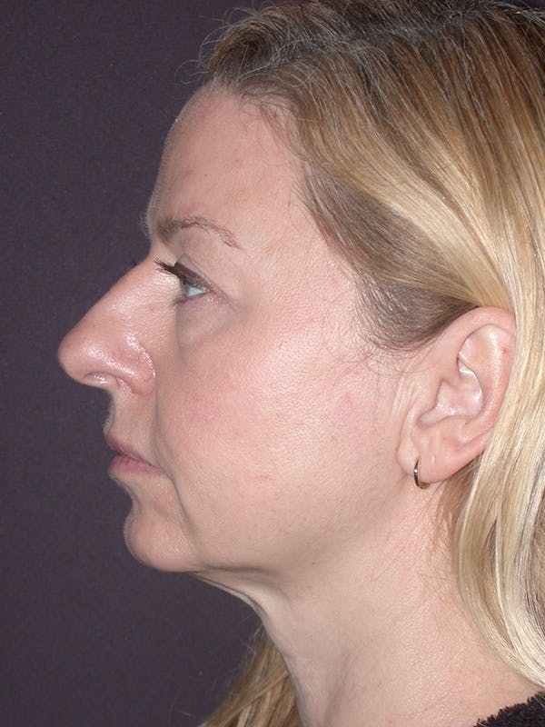 Facelift Gallery Before & After Gallery - Patient 120815835 - Image 3