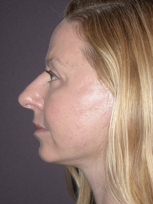 Eyelid Lift Gallery Before & After Gallery - Patient 120815837 - Image 4