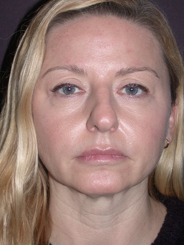 Facelift Gallery Before & After Gallery - Patient 120815835 - Image 5