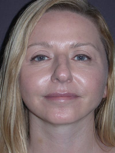Facelift Gallery Before & After Gallery - Patient 120815835 - Image 6