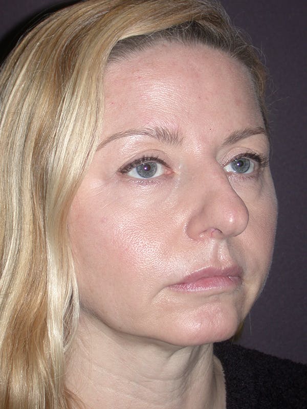 Eyelid Lift Gallery Before & After Gallery - Patient 120815837 - Image 7