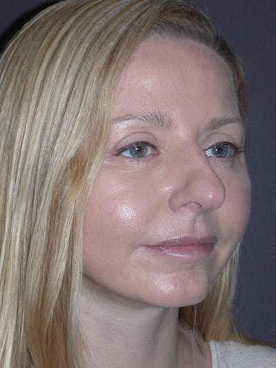 Facelift Gallery Before & After Gallery - Patient 120815835 - Image 8