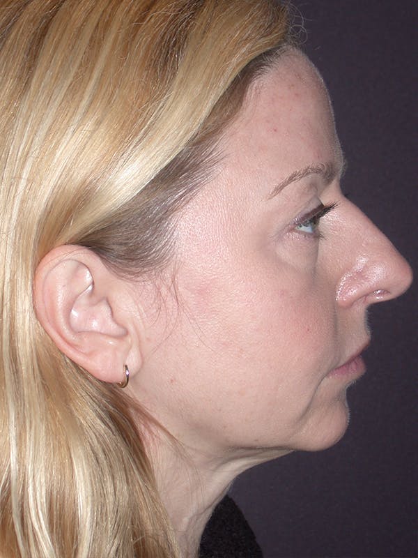 Facelift Gallery Before & After Gallery - Patient 120815835 - Image 9