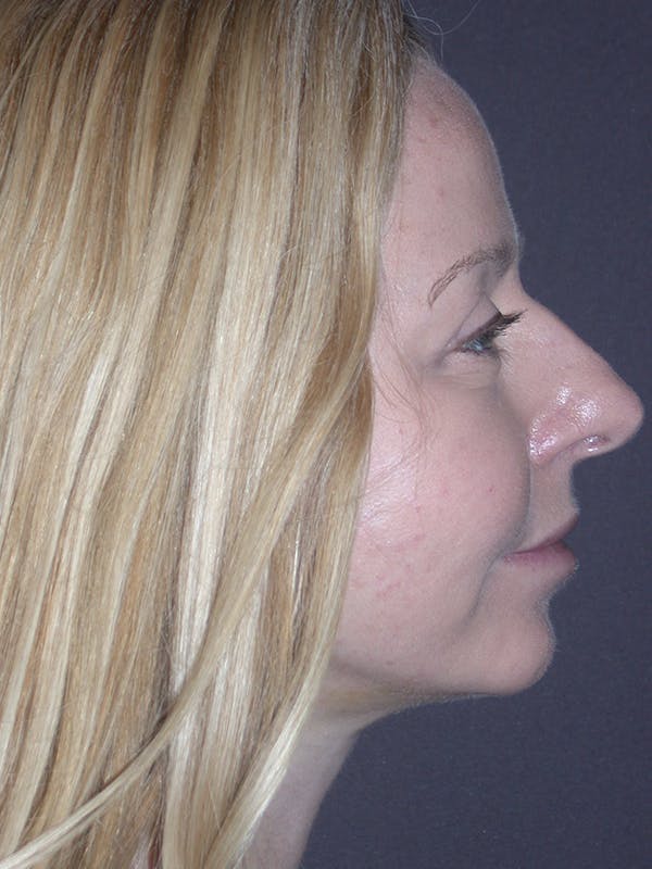 Facelift Gallery Before & After Gallery - Patient 120815835 - Image 10