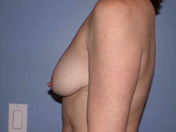 Breast Lift Gallery Before & After Gallery - Patient 140819633 - Image 3