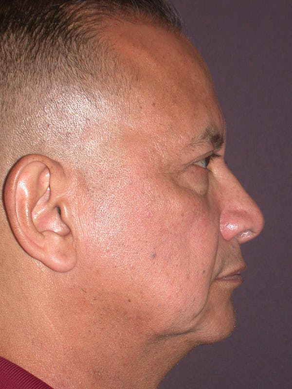 Male Facial Procedures Gallery - Patient 140819883 - Image 5