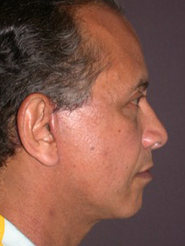 Male Facial Procedures Gallery Before & After Gallery - Patient 140819883 - Image 6