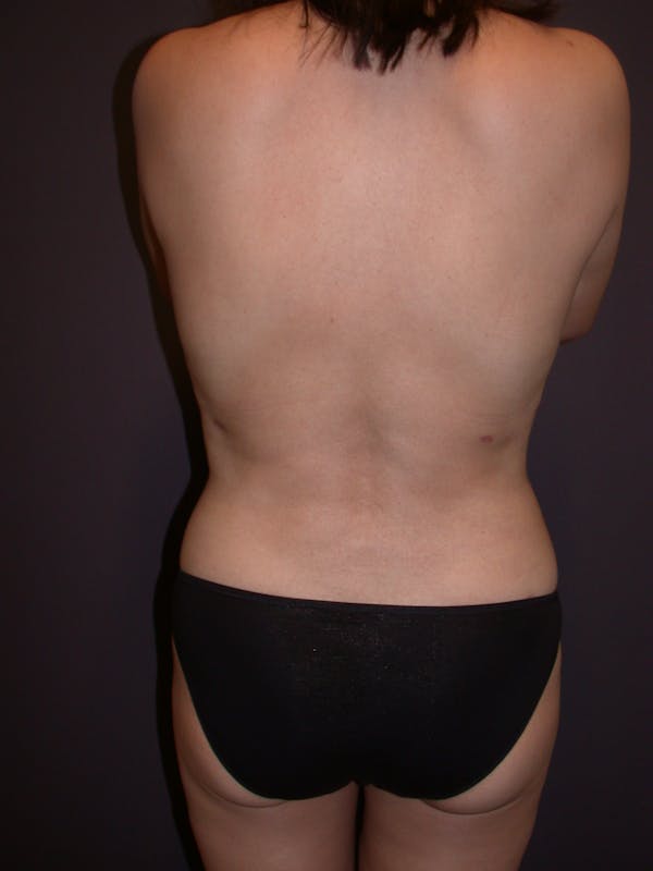Liposuction Before & After Gallery - Patient 140794300 - Image 8