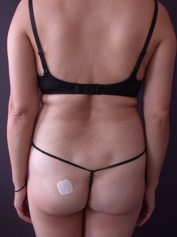 Liposuction Gallery Before & After Gallery - Patient 140794300 - Image 7