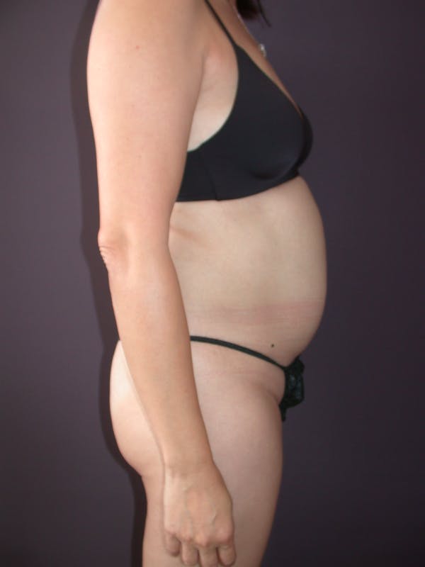 Liposuction Gallery Before & After Gallery - Patient 140794300 - Image 5