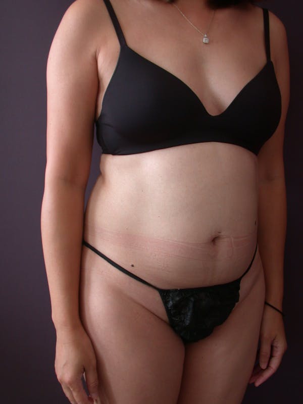 Liposuction Gallery Before & After Gallery - Patient 140794300 - Image 3