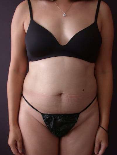 Liposuction Gallery Before & After Gallery - Patient 140794300 - Image 1