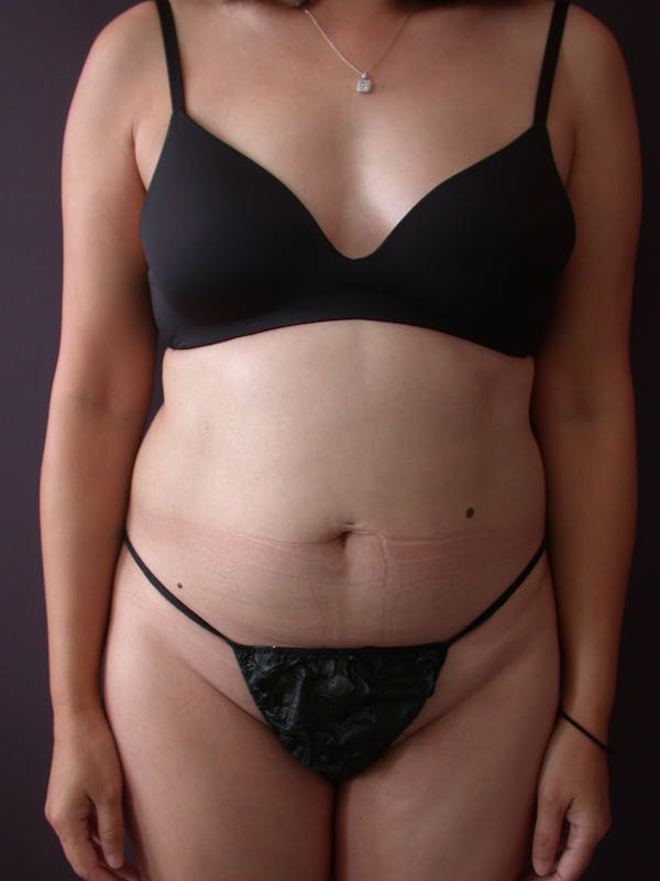 Liposuction Gallery Before & After Gallery - Patient 140794300 - Image 1