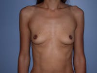 Breast Augmentation Gallery Before & After Gallery - Patient 140794206 - Image 1