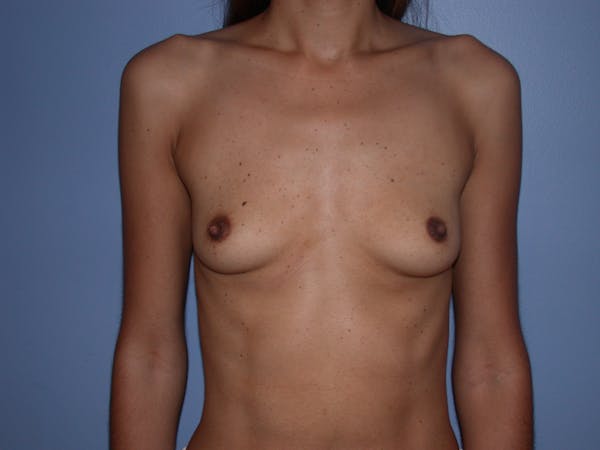 Breast Augmentation Before & After Gallery - Patient 140794206 - Image 1