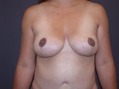 Breast Lift Gallery Before & After Gallery - Patient 140794171 - Image 2