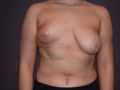 Tubular Breasts Gallery Before & After Gallery - Patient 140794316 - Image 1