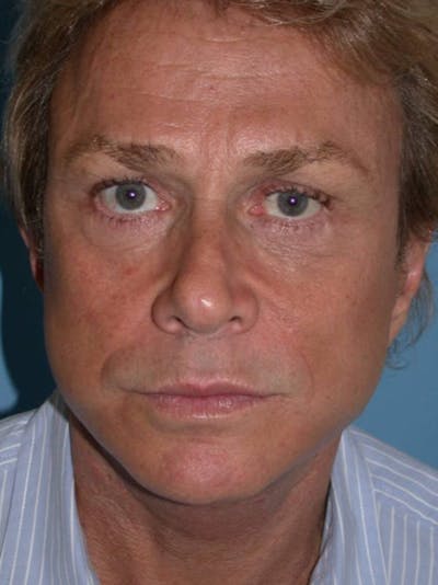 Male Facial Procedures Gallery Before & After Gallery - Patient 6096738 - Image 2