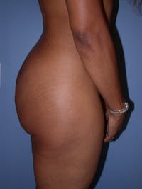 Brazilian Butt Lift Before & After Gallery - Patient 140821191 - Image 1