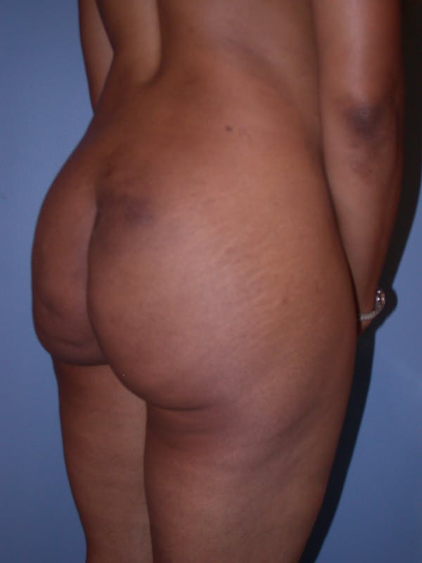 Brazilian Butt Lift Gallery - Patient 140821191 - Image 3