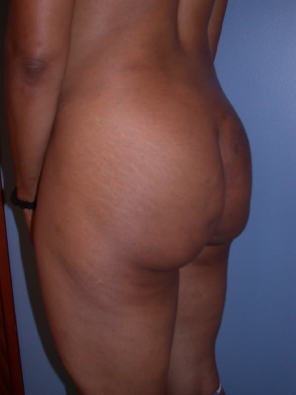 Brazilian Butt Lift Gallery Before & After Gallery - Patient 140821191 - Image 5