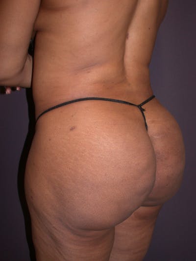 Brazilian Butt Lift Gallery Before & After Gallery - Patient 140821191 - Image 6
