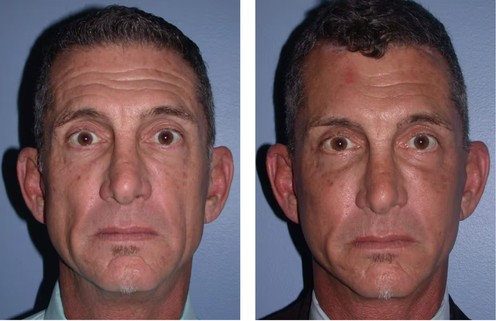 Before and After Facelift