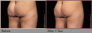 Aveli Cellulite Treatment
