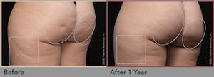 Aveli Cellulite Treatment
