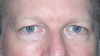 Eyelid Lift Gallery Before & After Gallery - Patient 148101158 - Image 1