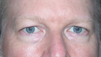 Eyelid Lift Gallery Before & After Gallery - Patient 148101158 - Image 1